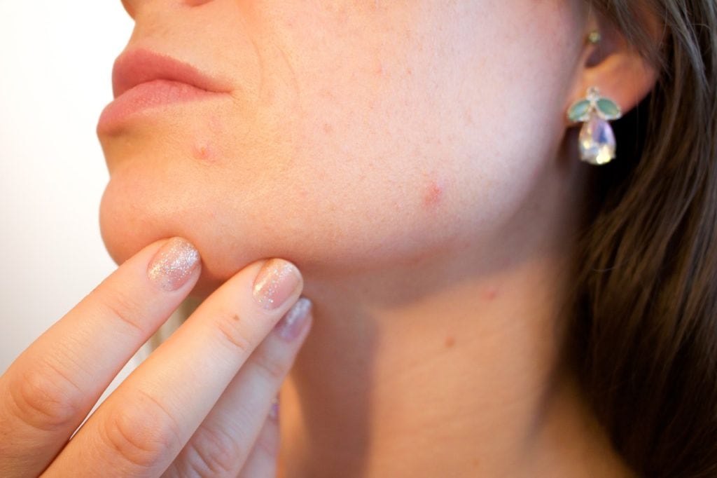 Acne: How to Get Rid of it Quickly