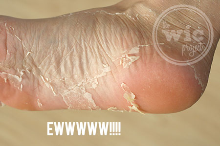 Baby Foot Peel Results